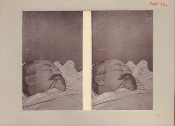 LESSER, Adolf Professor Dr.  Stereoskopischer gerichtsärztlicher Atlas. - Image 9