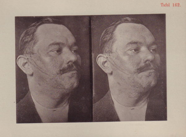 LESSER, Adolf Professor Dr.  Stereoskopischer gerichtsärztlicher Atlas. - Image 10